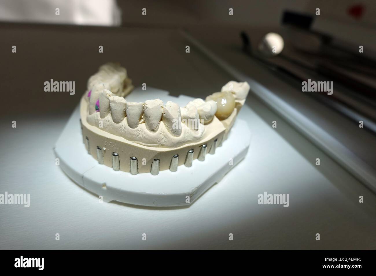 Zahnmodell eines Unterkiefers mit einer Krone Stock Photo