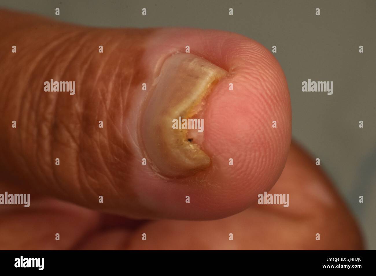 Plicatured nail condition may relate to other medical conditions. Stock Photo