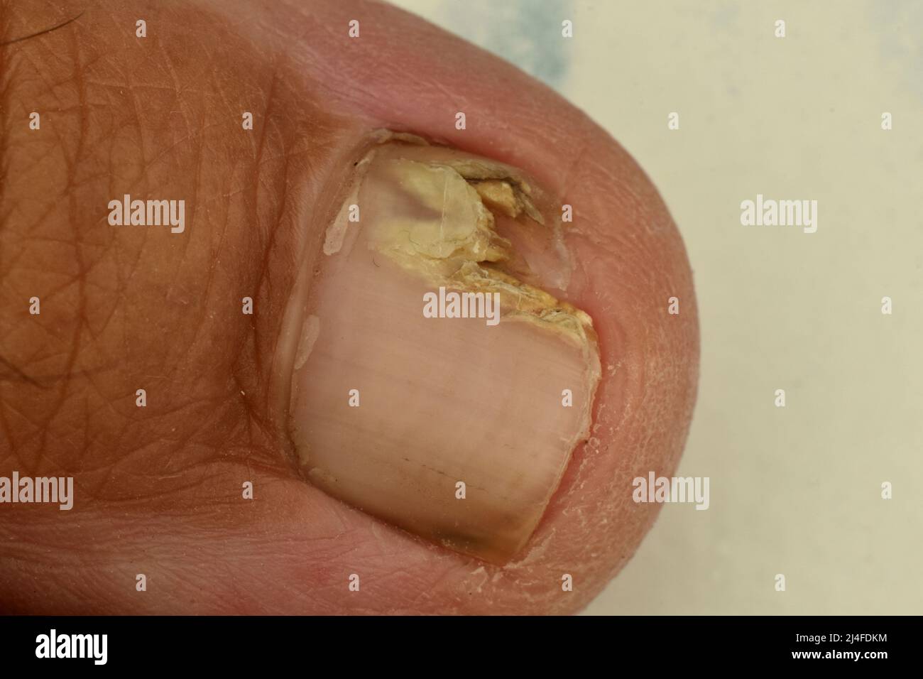 Nail abnormalities may relate to other medical conditions. Broken nail. Stock Photo