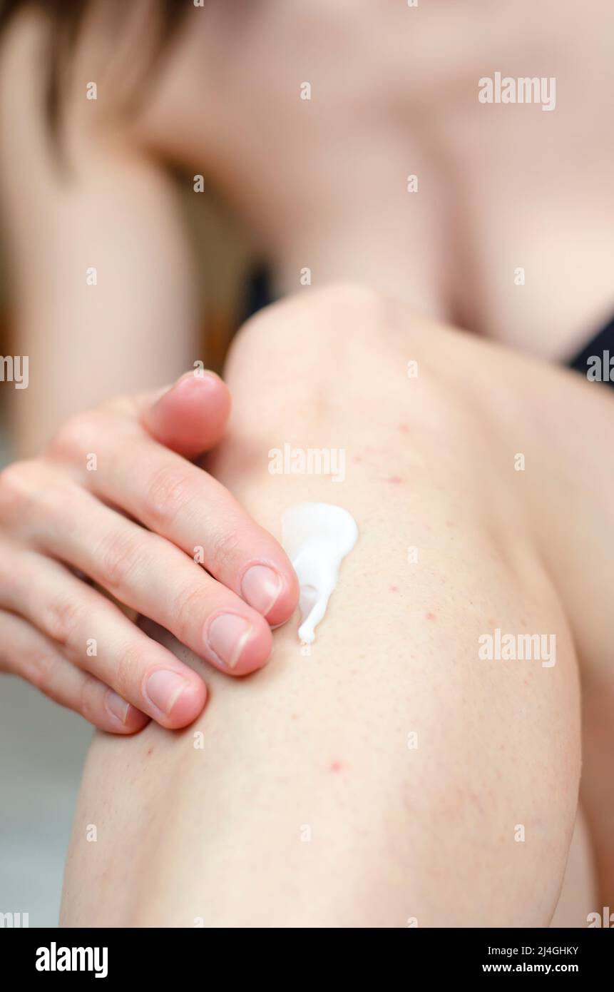 Open jar of cream in a female hand. Acne cream. Irritation after depilation. Stock Photo