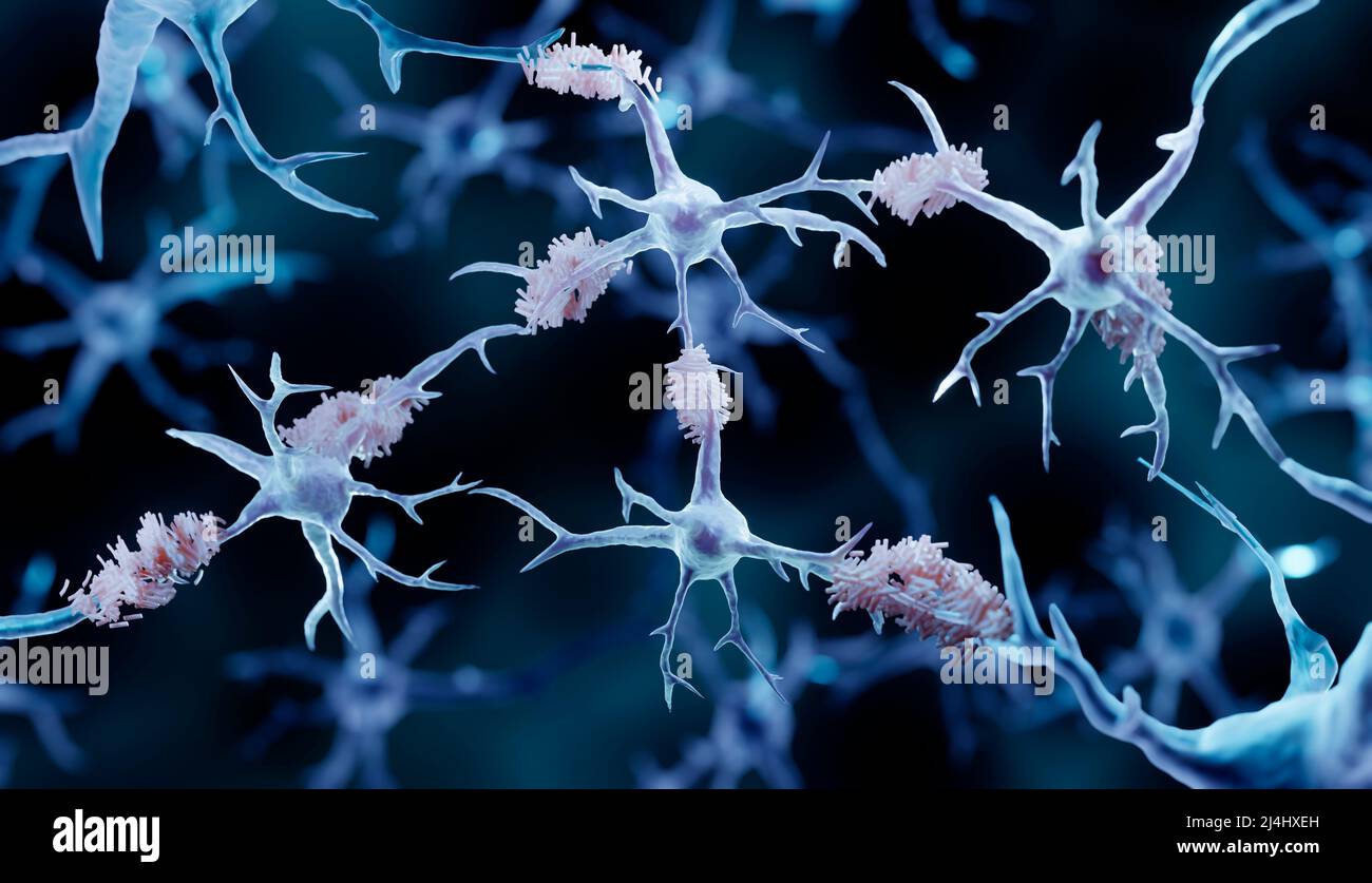 Amyloid plaques, illustration Stock Photo Alamy