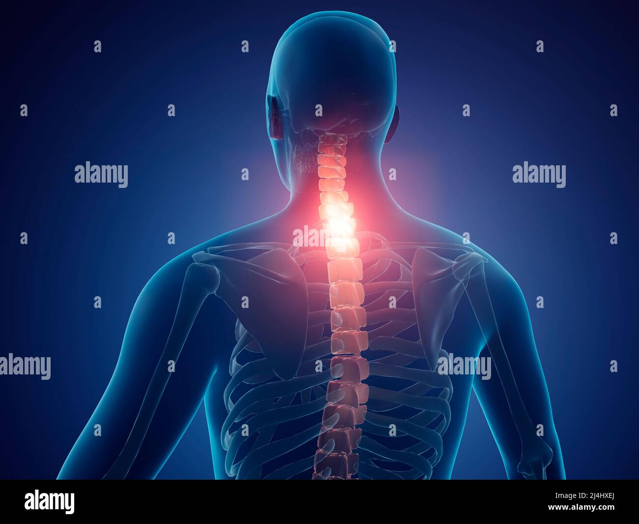 Neck pain, illustration Stock Photo Alamy