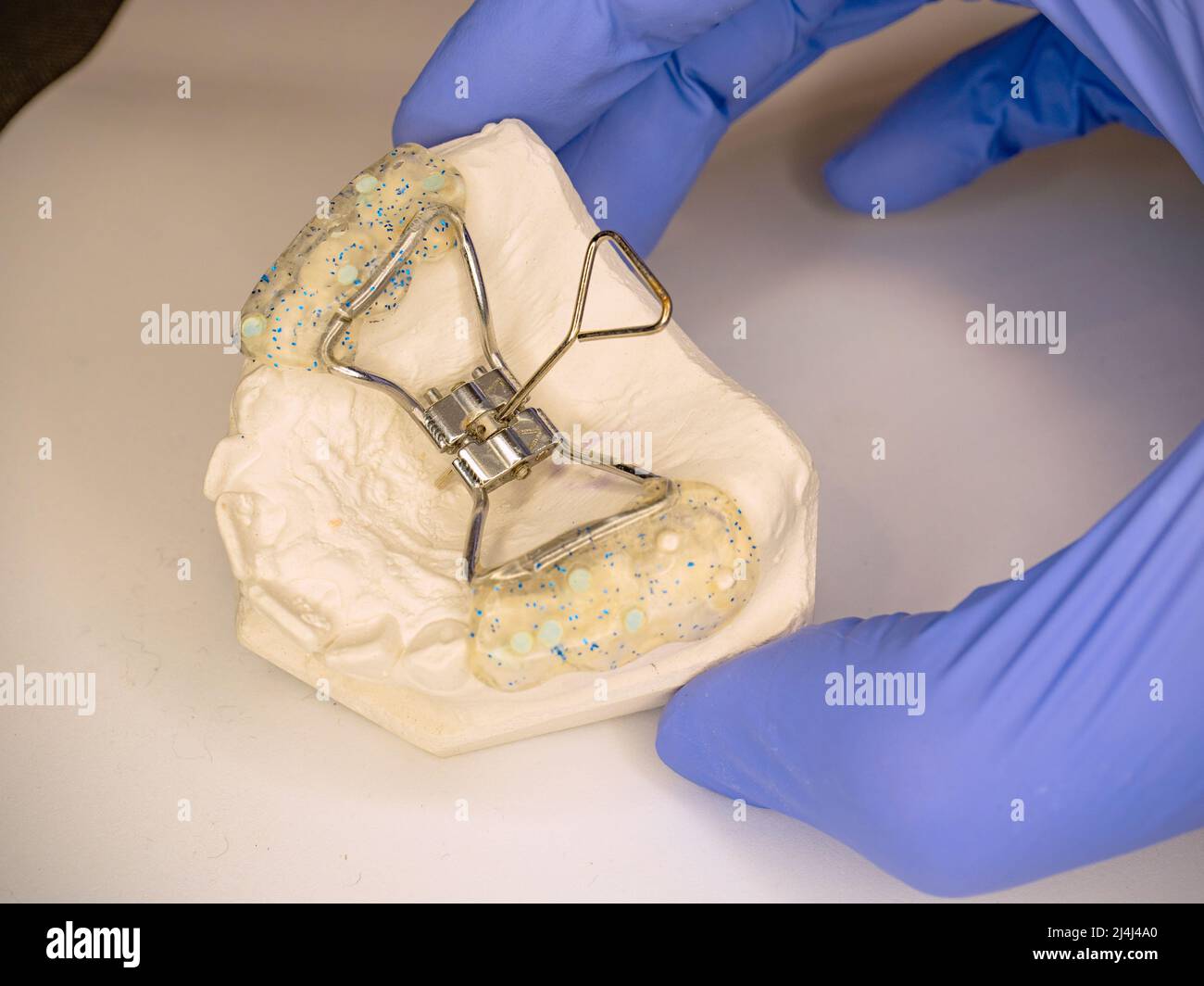 Modern children dental braces. Hyrax Rapid Palatal Expansion Braces. Retainer adjustable steel