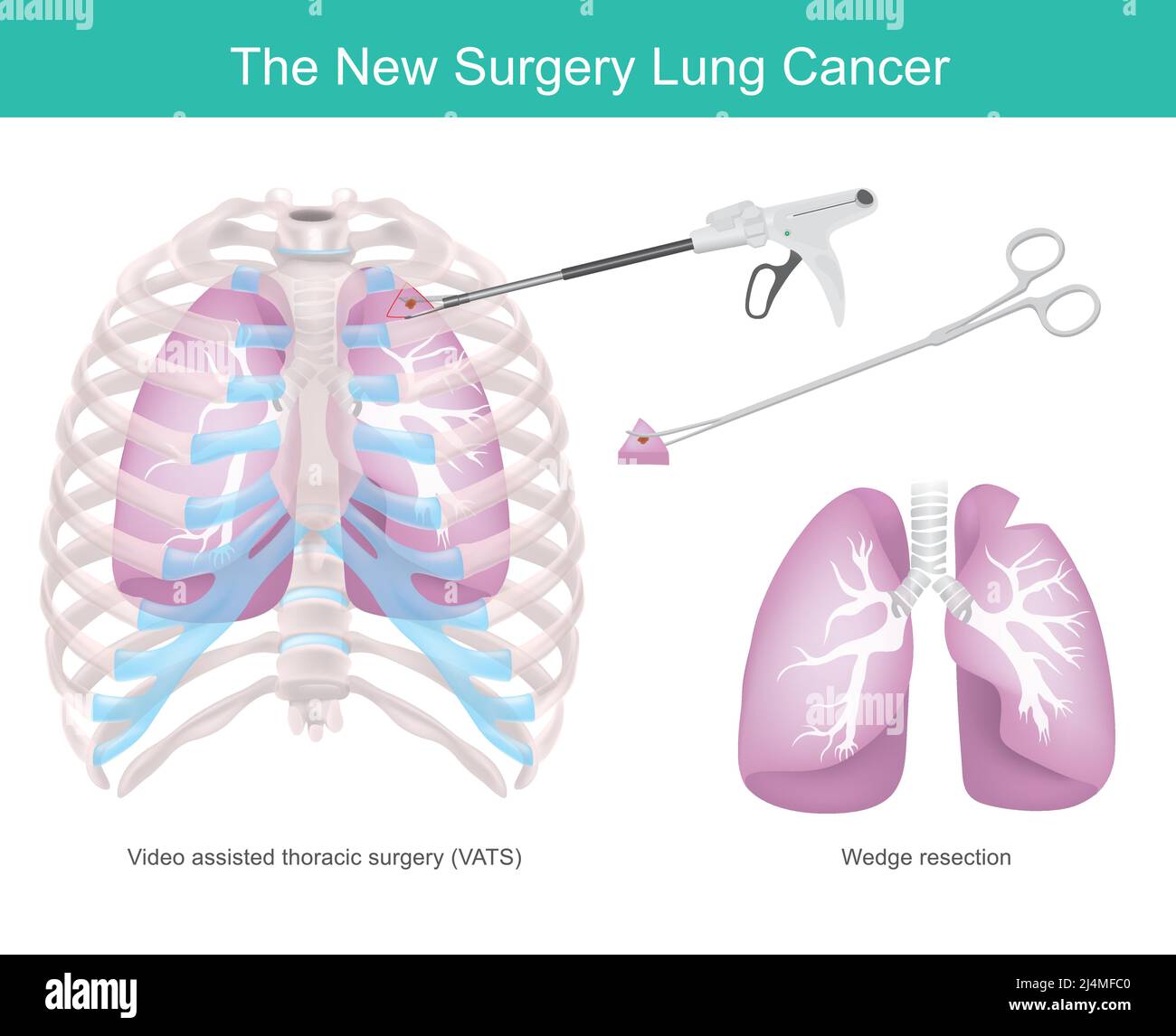 Surgical Technique For Lung Cancer. Surgical technique removing some part of the lung due to cancer. Stock Vector