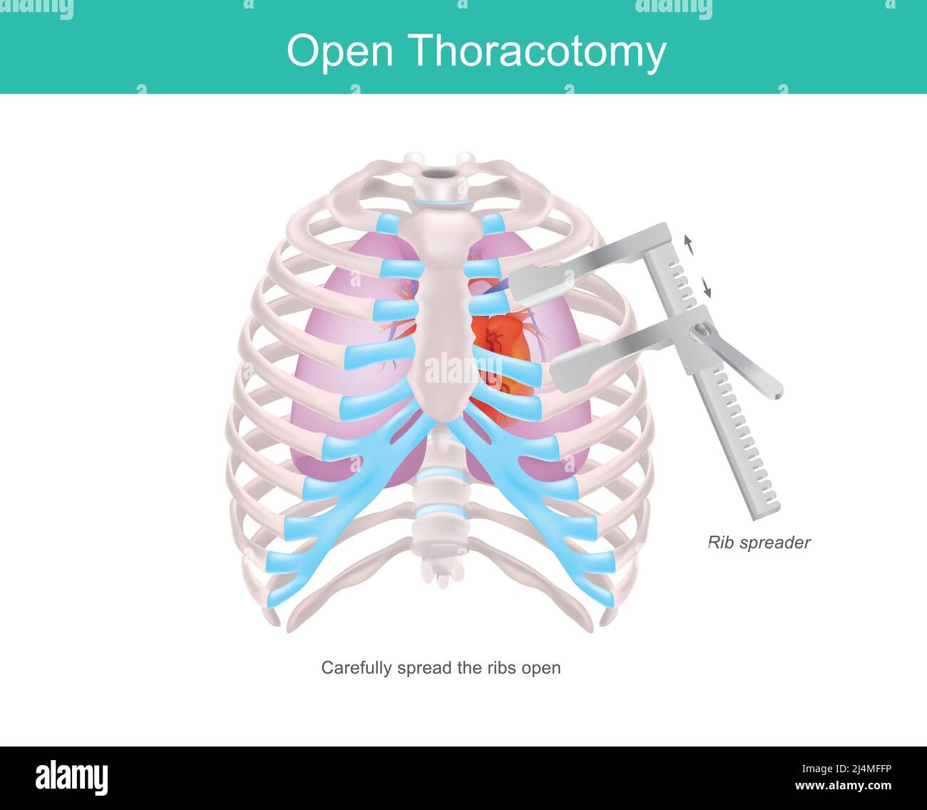 Open Thoracotomy. A procedure to gain access into the pleural space of the human chest by medical tool called Rib spreader. Stock Vector