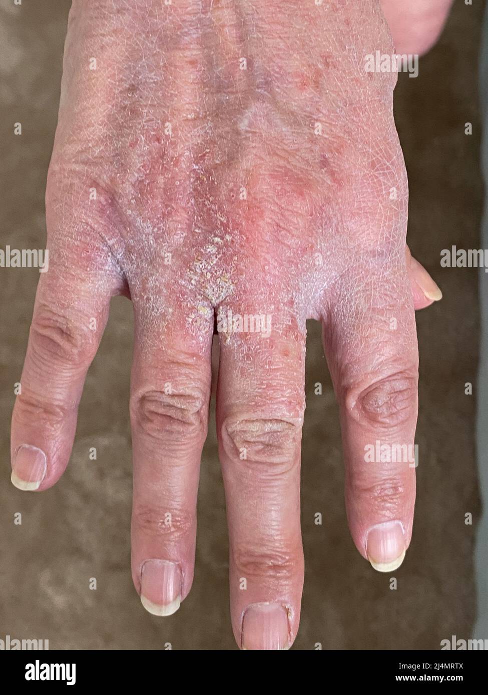 Hand with skin infection Stock Photo