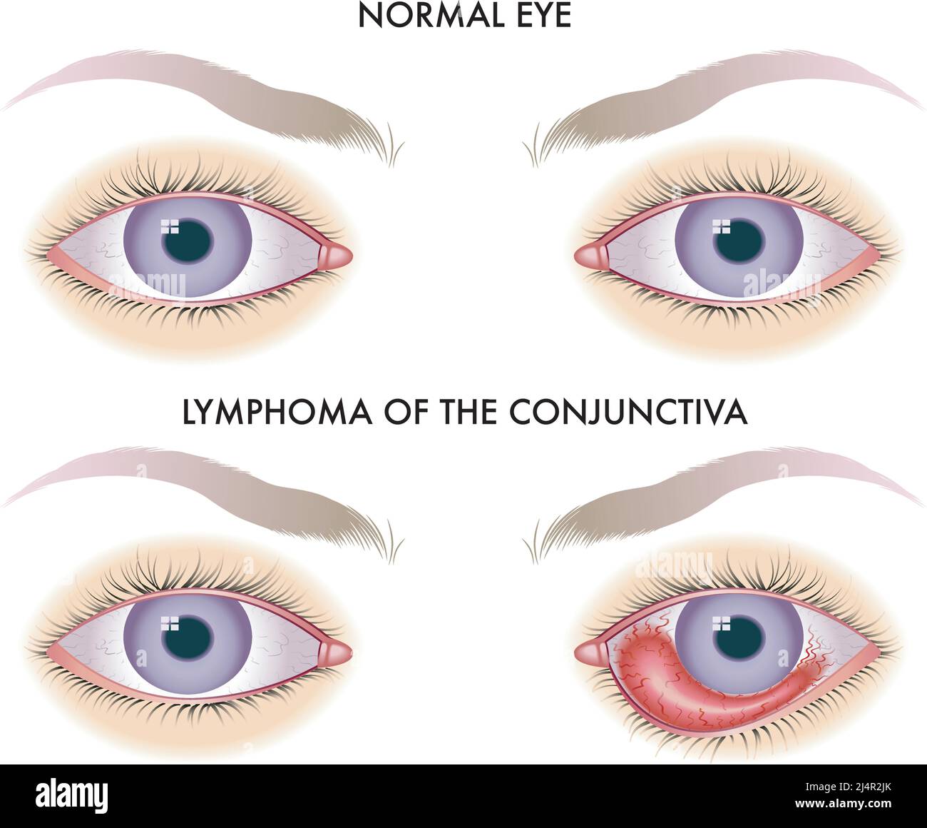 Medical illustration compares a healthy eye with one affected by lymphoma of the conjunctiva. Stock Vector