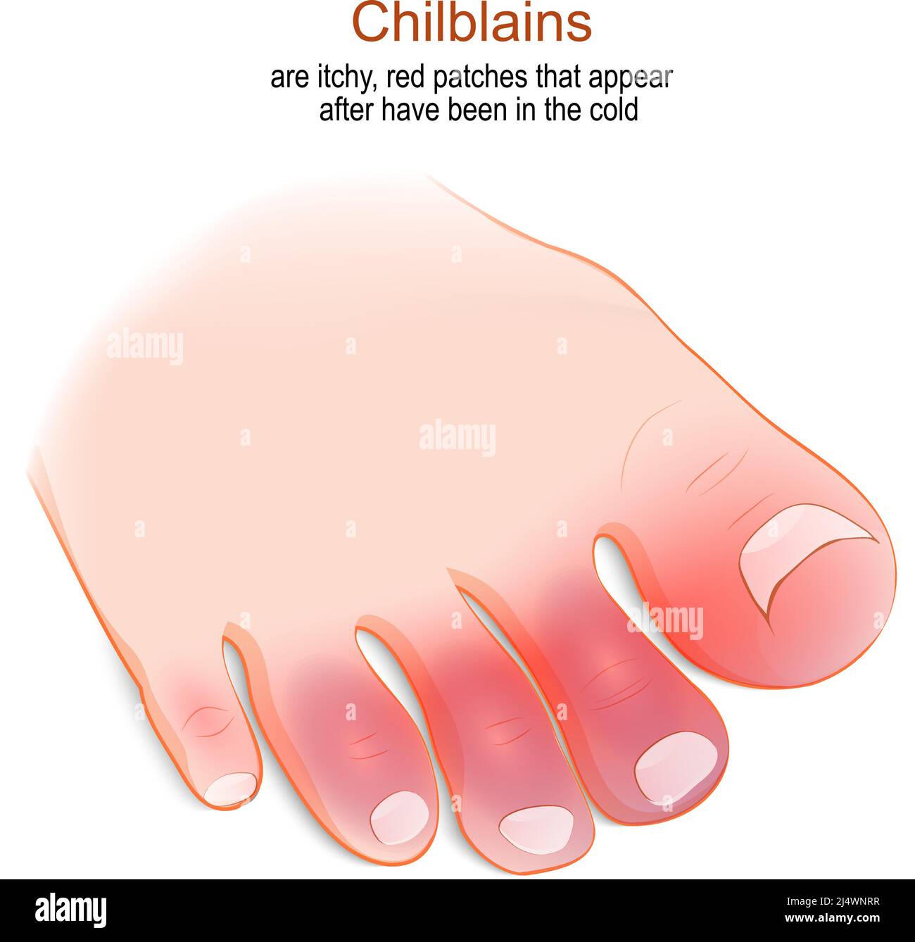 chilblain-toes-stock-vector-images-alamy