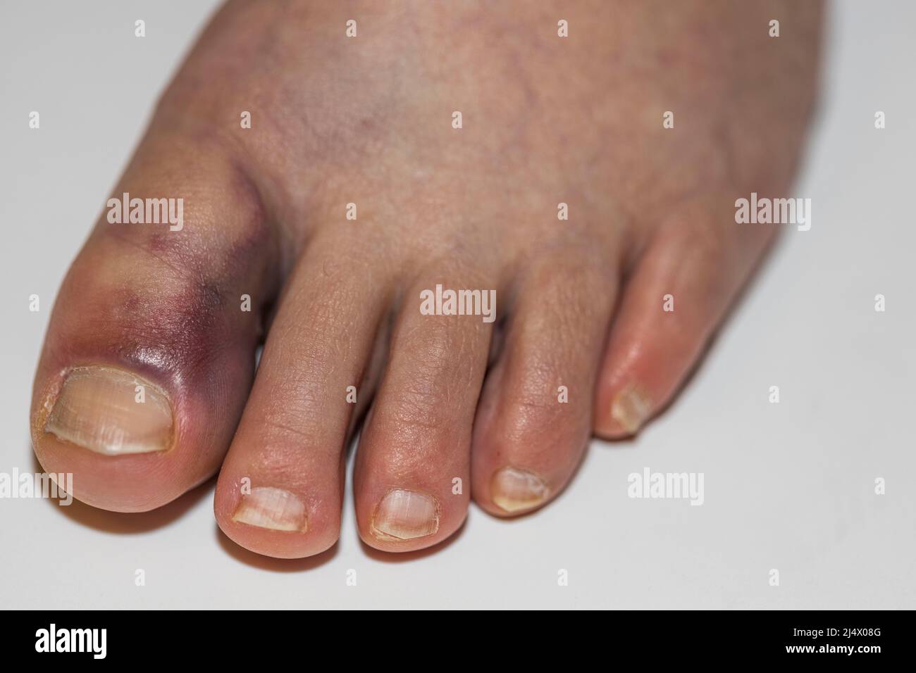 Close up view of damaged foot female with with bruise big toe. Injuries