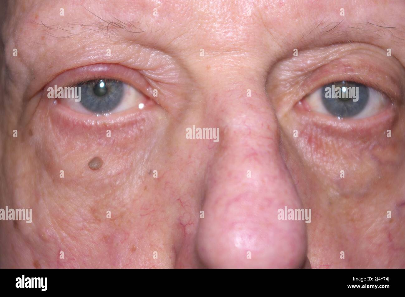 close up of eye with conjunctivitis Stock Photo