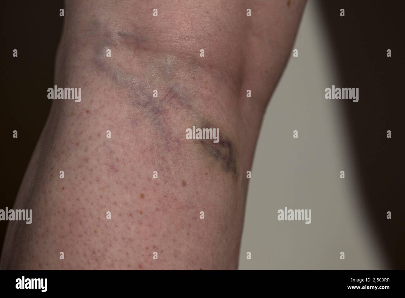 Varicose veins and bruise on back of leg Stock Photo