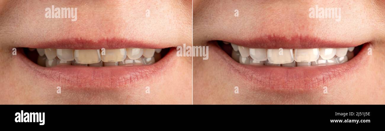 Smile before and after using bleaching agent, toothpaste, professional