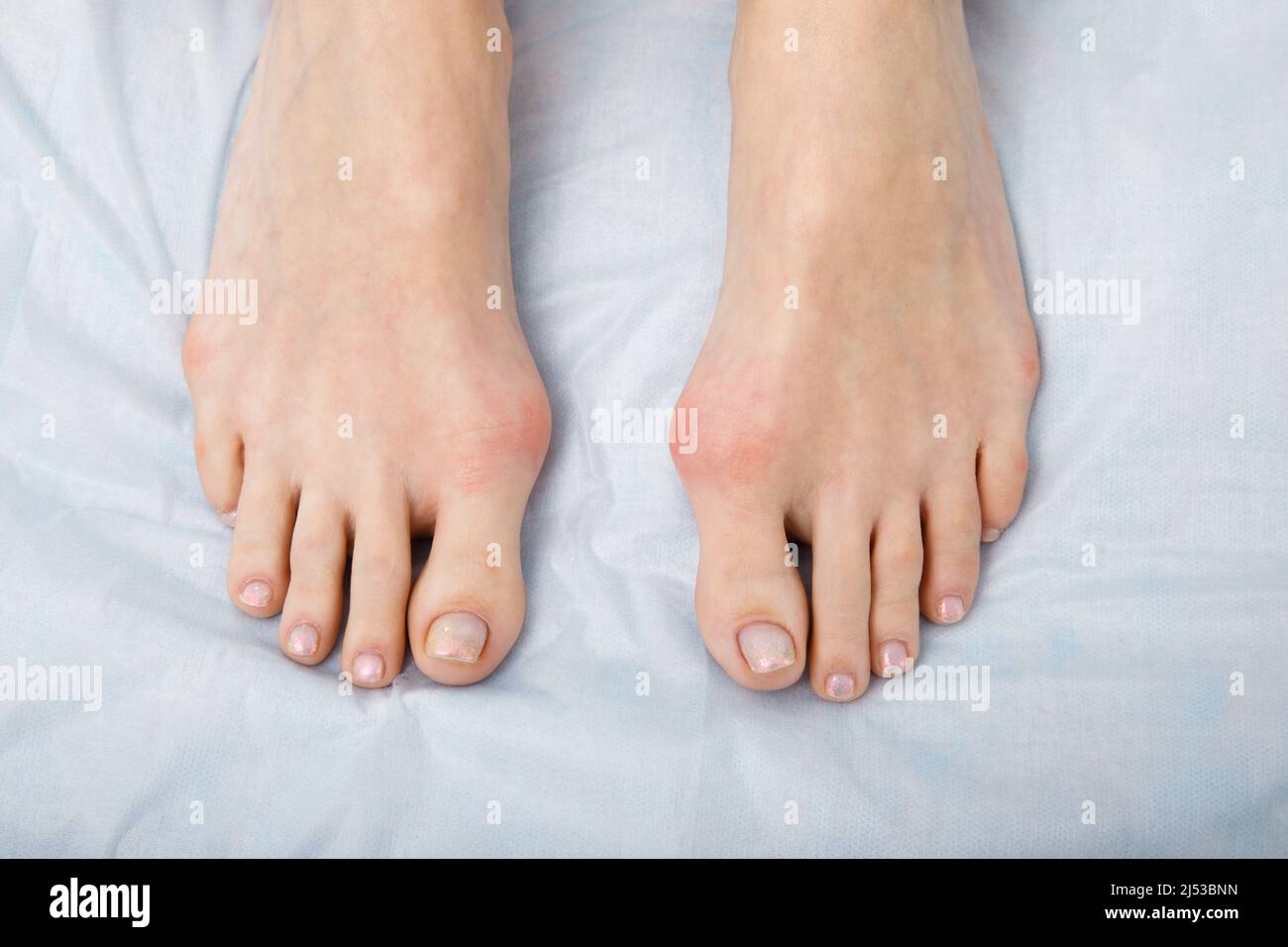The woman suffers from inflammation of the big toe bone. Hallux valgus, bunion in foot on white background. Stock Photo