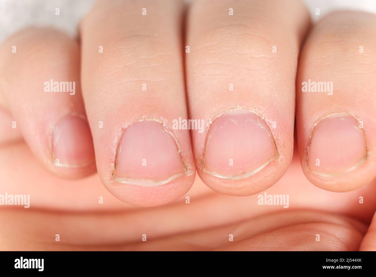 Unkempt male nails with a regrown cuticle on a white background Stock Photo