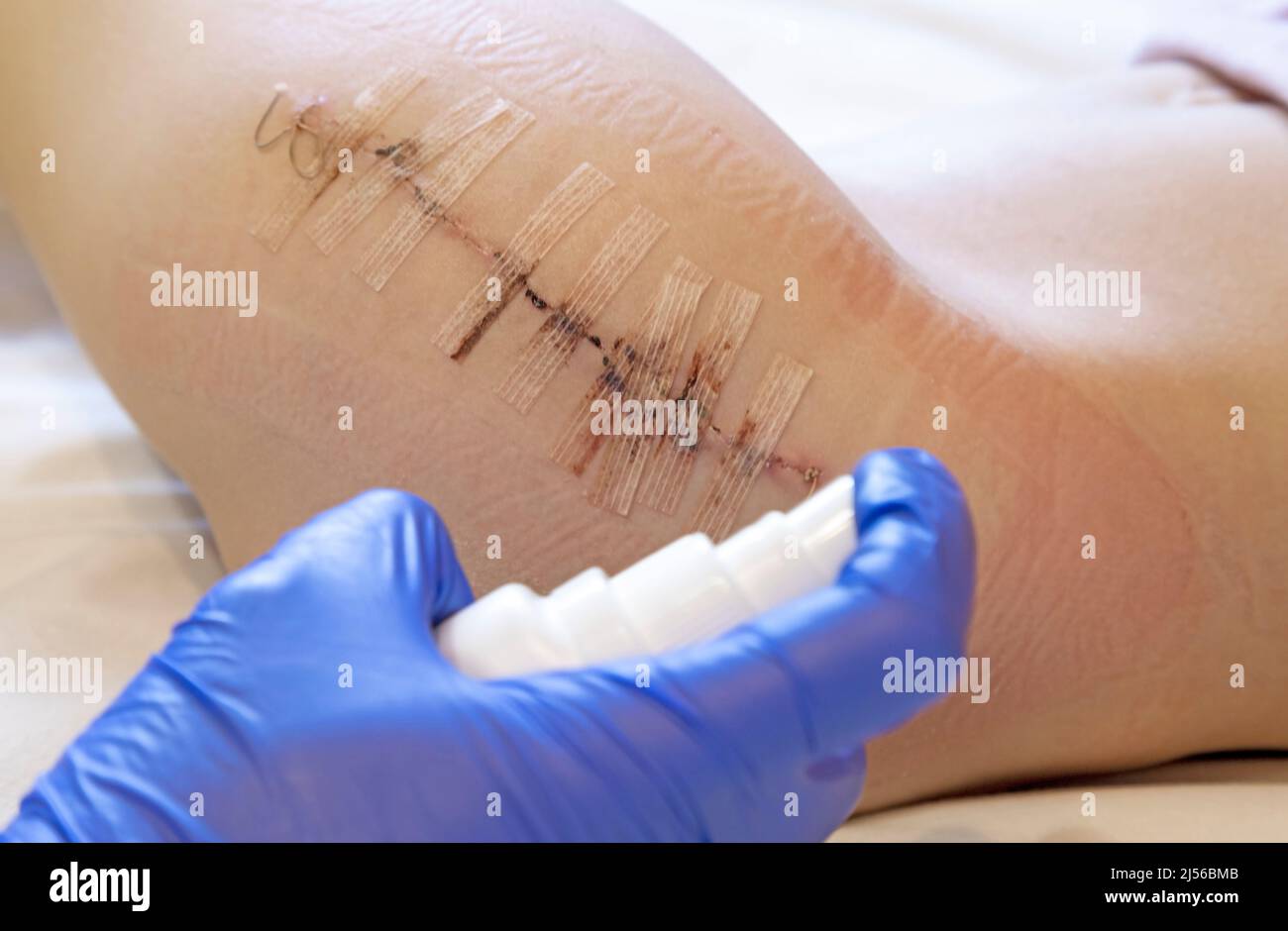 Hands of a doctor in blue gloves, a nurse or a doctor who treats the patient's wound after surgery and disinfects with antibacterial spray to clean Stock Photo