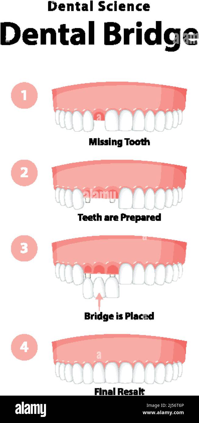 Infographic of human in dental bridge on white background illustration ...