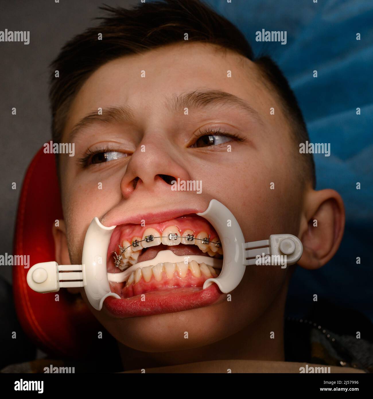 Visit to the orthodontist, installation of braces on the upper teeth