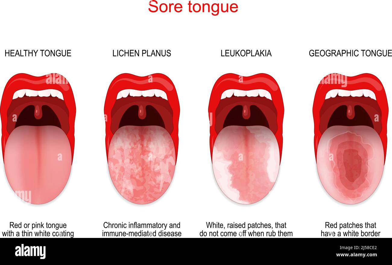 Lichen Planus Tongue Hairy Leukoplakia Differential Diagnoses