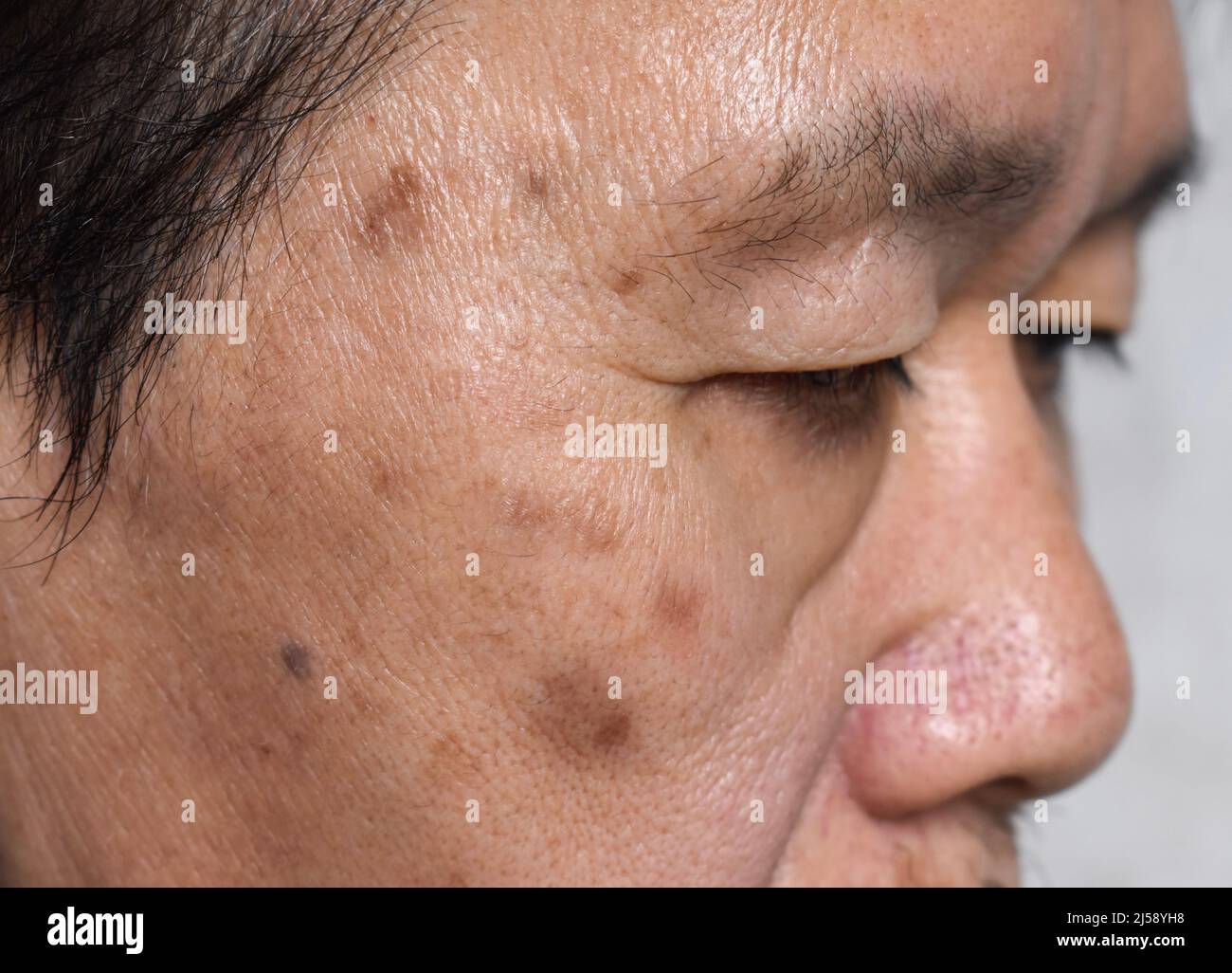 Small Brown Patches Called Age Spots On Face Of Asian Elder Man They Are Also Called Liver Spots Senile Lentigo Or Sun Spots Closeup View Stock Photo Alamy