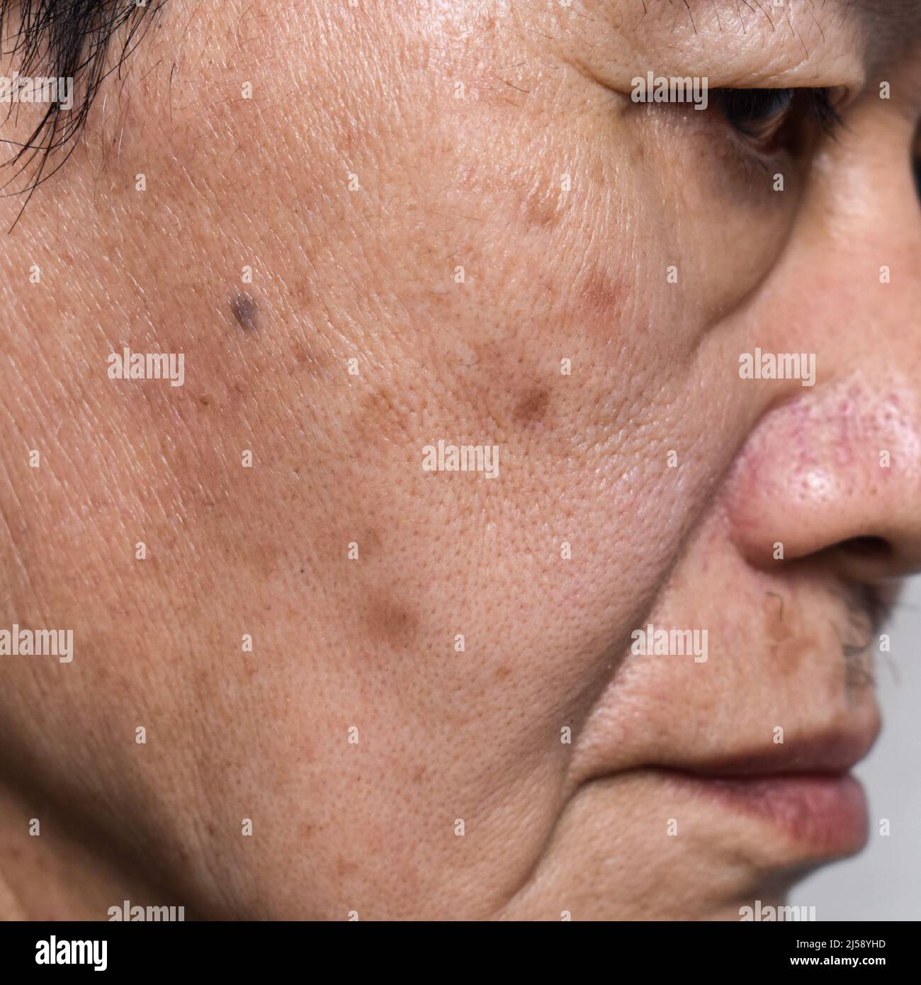 Small brown patches called age spots on face of Asian elder man. They are also called liver spots, senile lentigo, or sun spots. Closeup view. Stock Photo