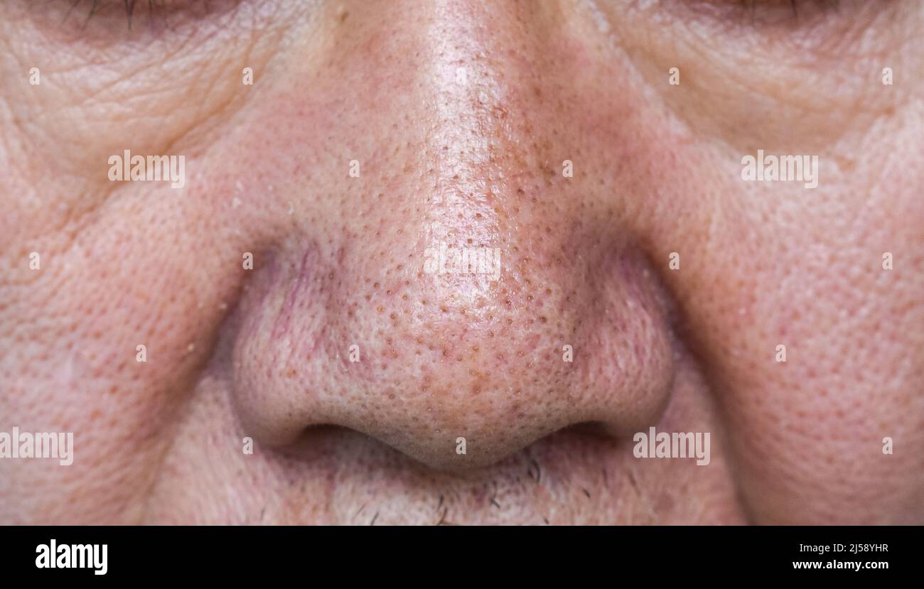 Blackheads or black heads on nose of Asian old man. They are small bumps that appear on skin due to clogged hair follicles. Stock Photo