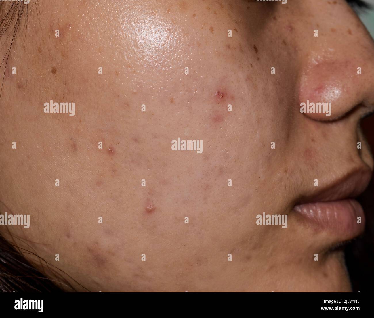 Acne, dark spots and scars on face of Asian young woman. Stock Photo