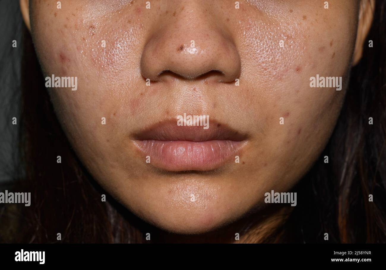 Acne, dark spots and scars on face of Asian young woman. Stock Photo