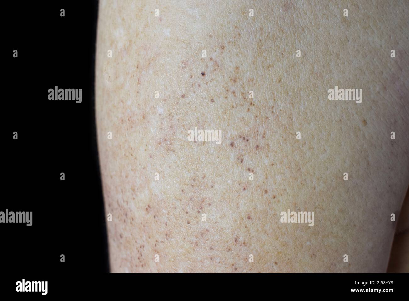 Age spots and white patches on arm of Asian elder man. Age spots are