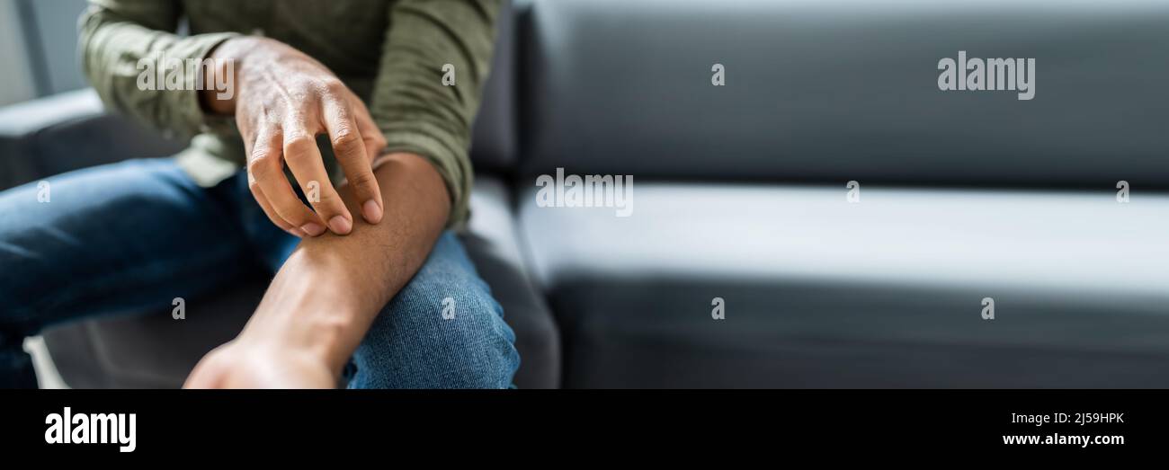 Arm rash african american hires stock photography and images Alamy