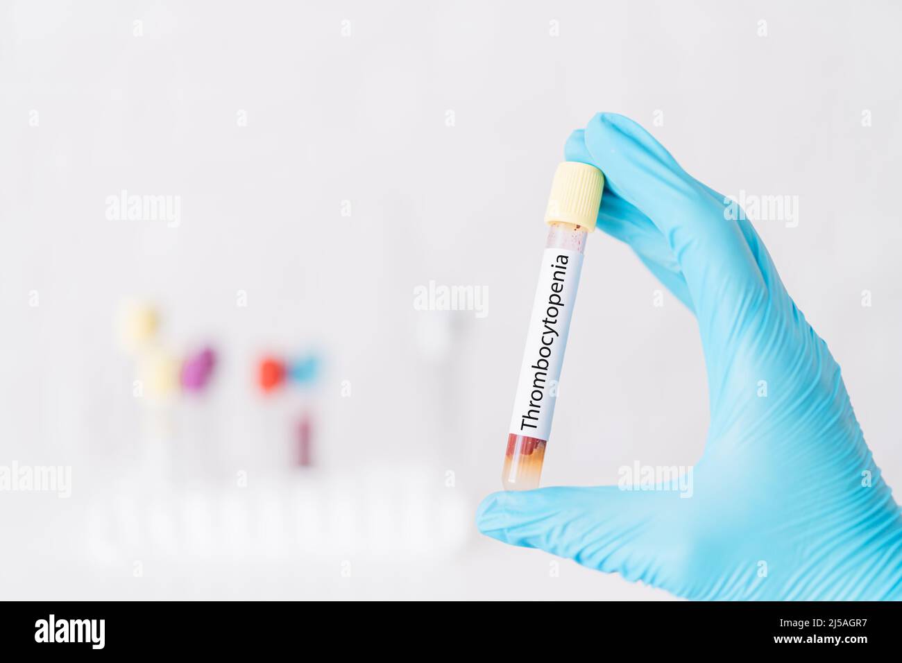 Hand holding test tube of blood with the inscription thrombocytopenia Stock Photo