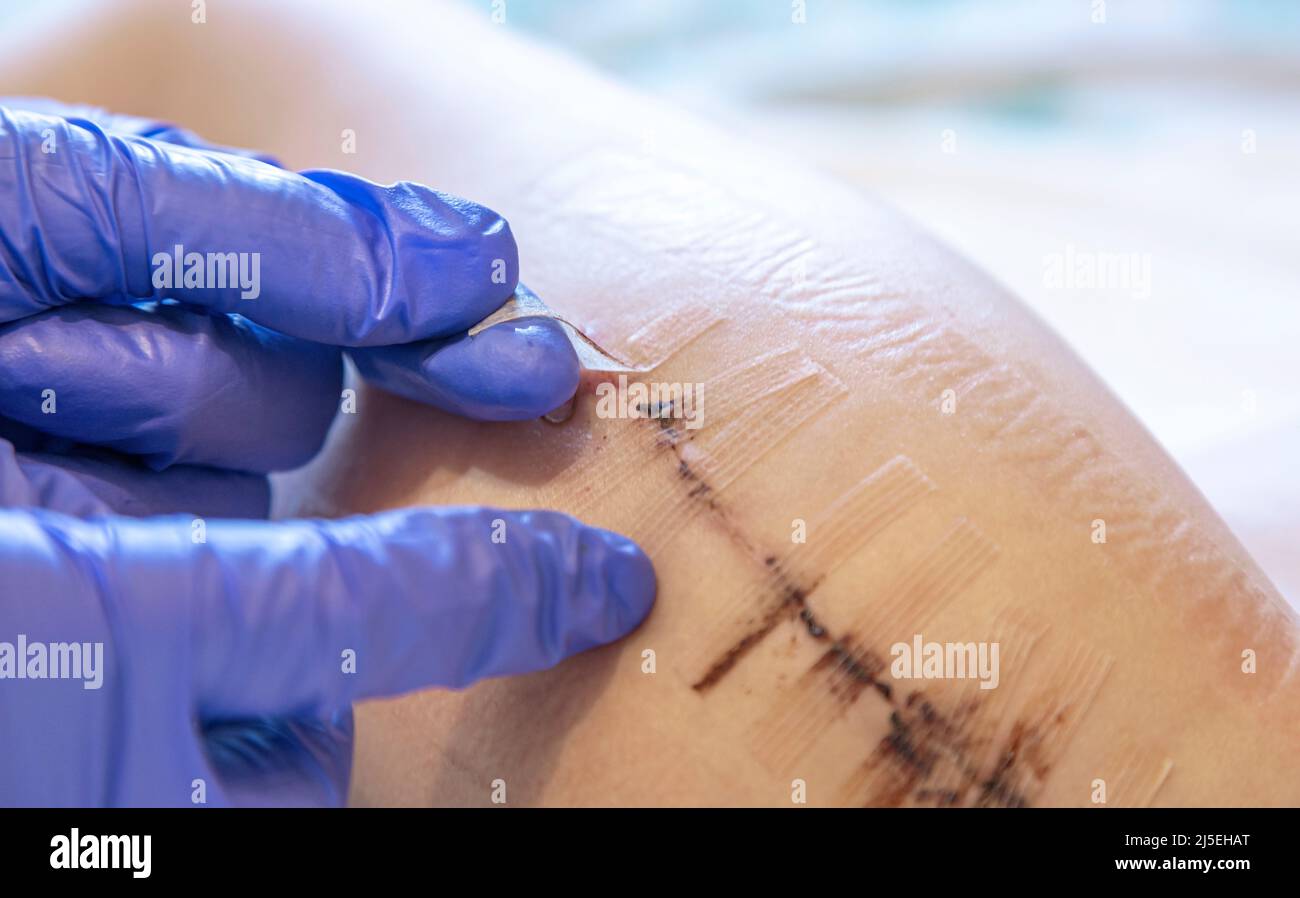 Removing Surgical Tape: All Your Questions Answered