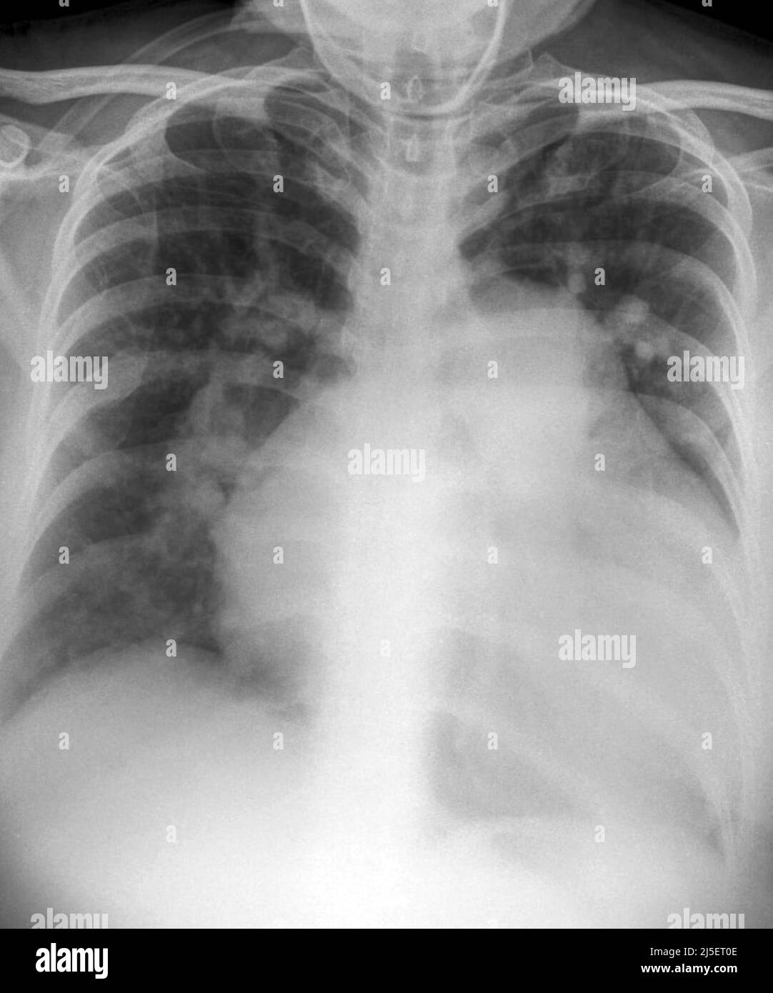 Cardiomyopathy x ray hires stock photography and images Alamy