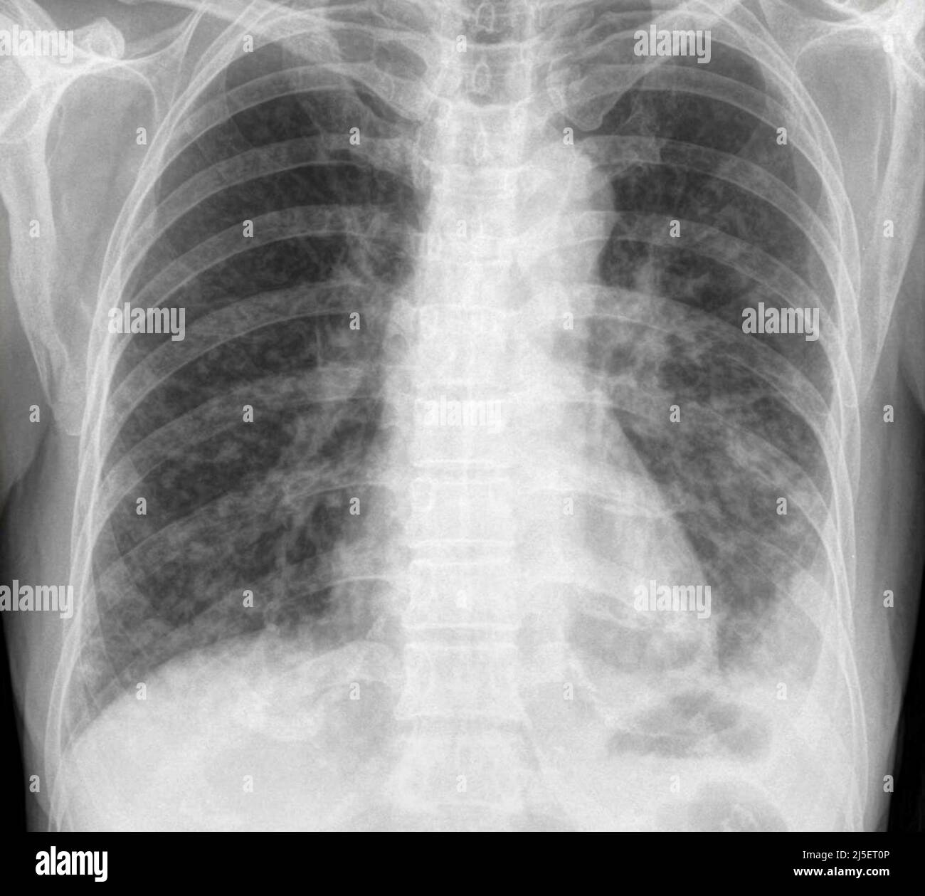 Miliary nodules, X-ray Stock Photo