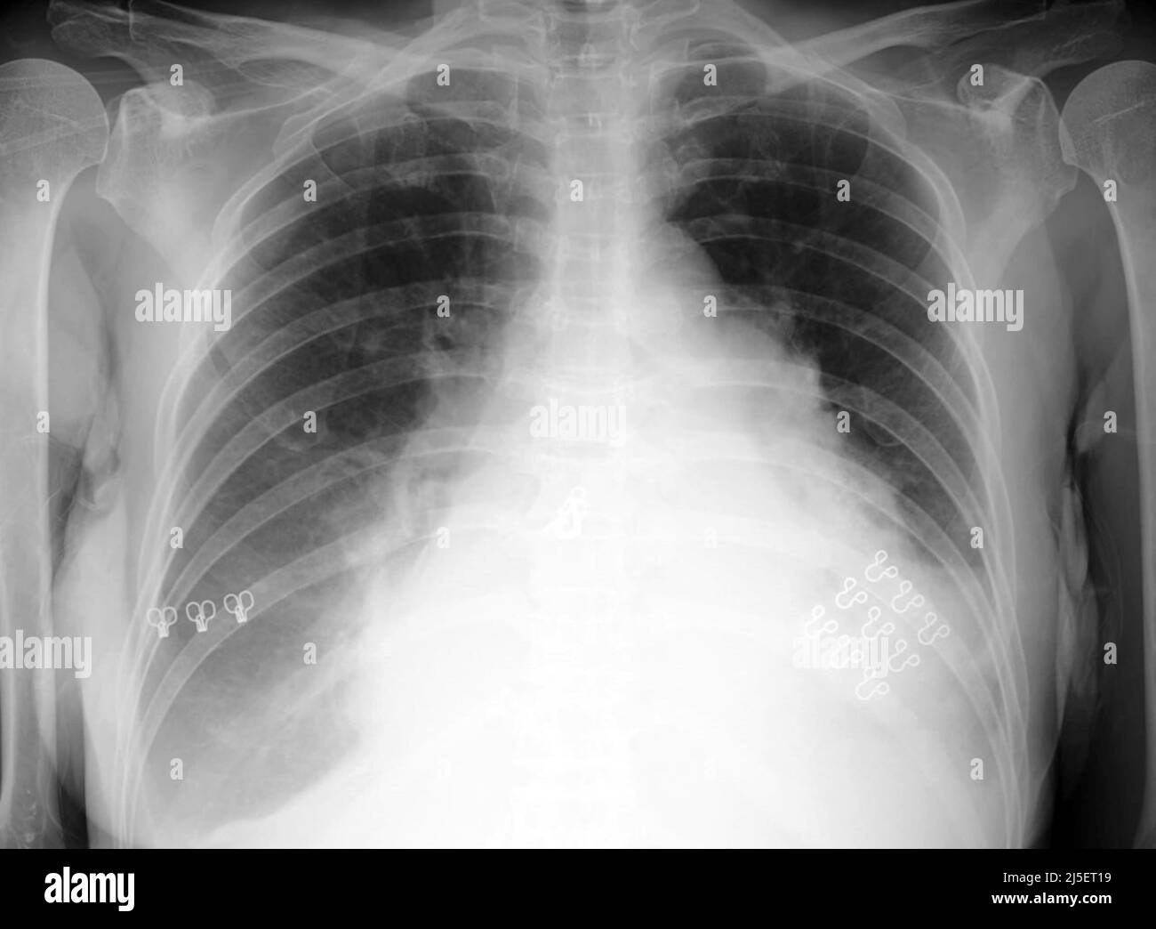 Enlarged heart, X-ray Stock Photo - Alamy