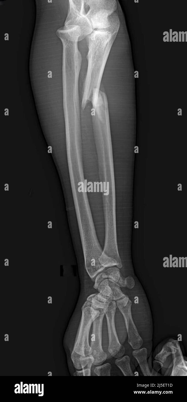 Monteggia fracture, Xray Stock Photo Alamy