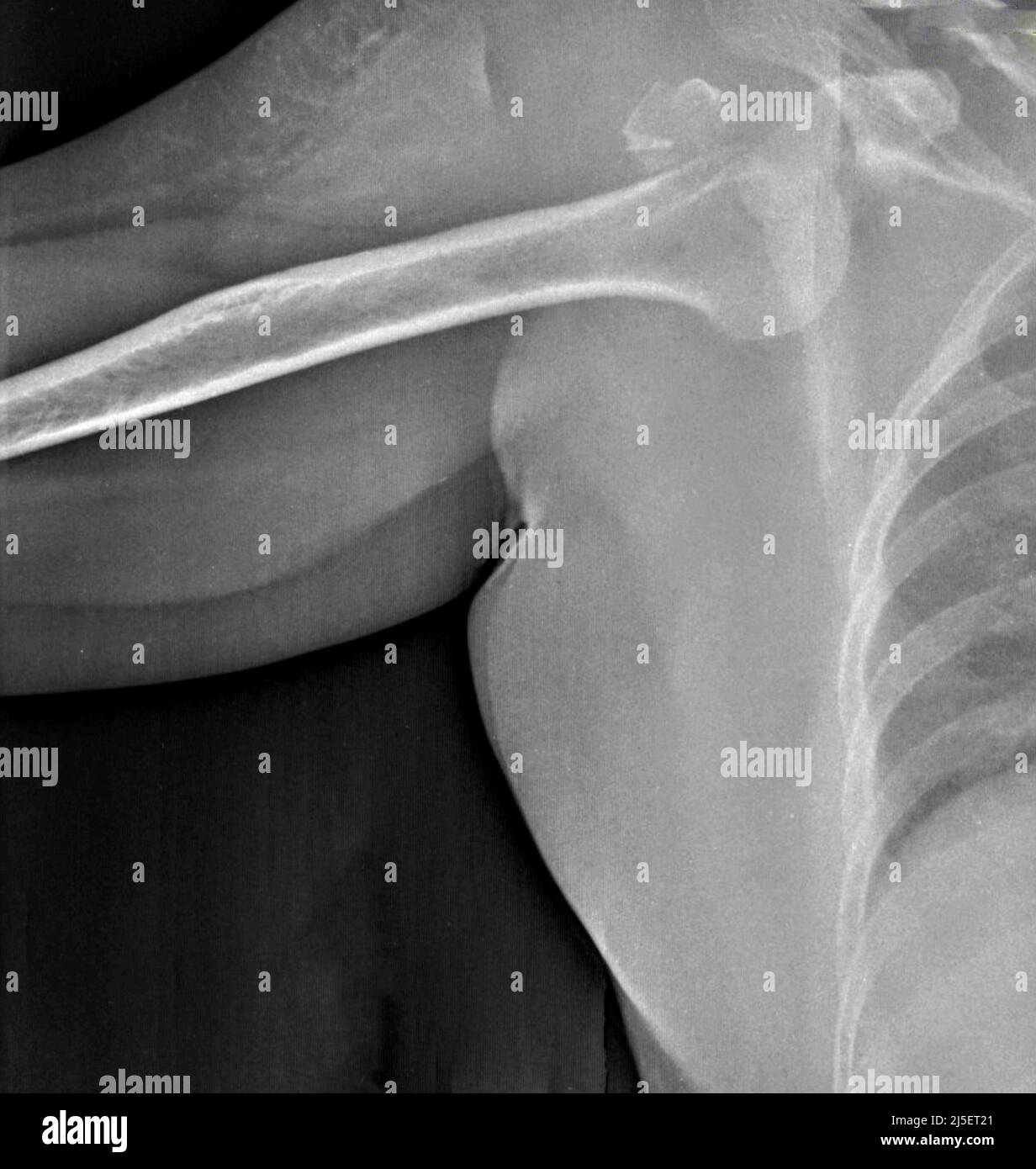 Dislocated shoulder x ray hires stock photography and images Alamy