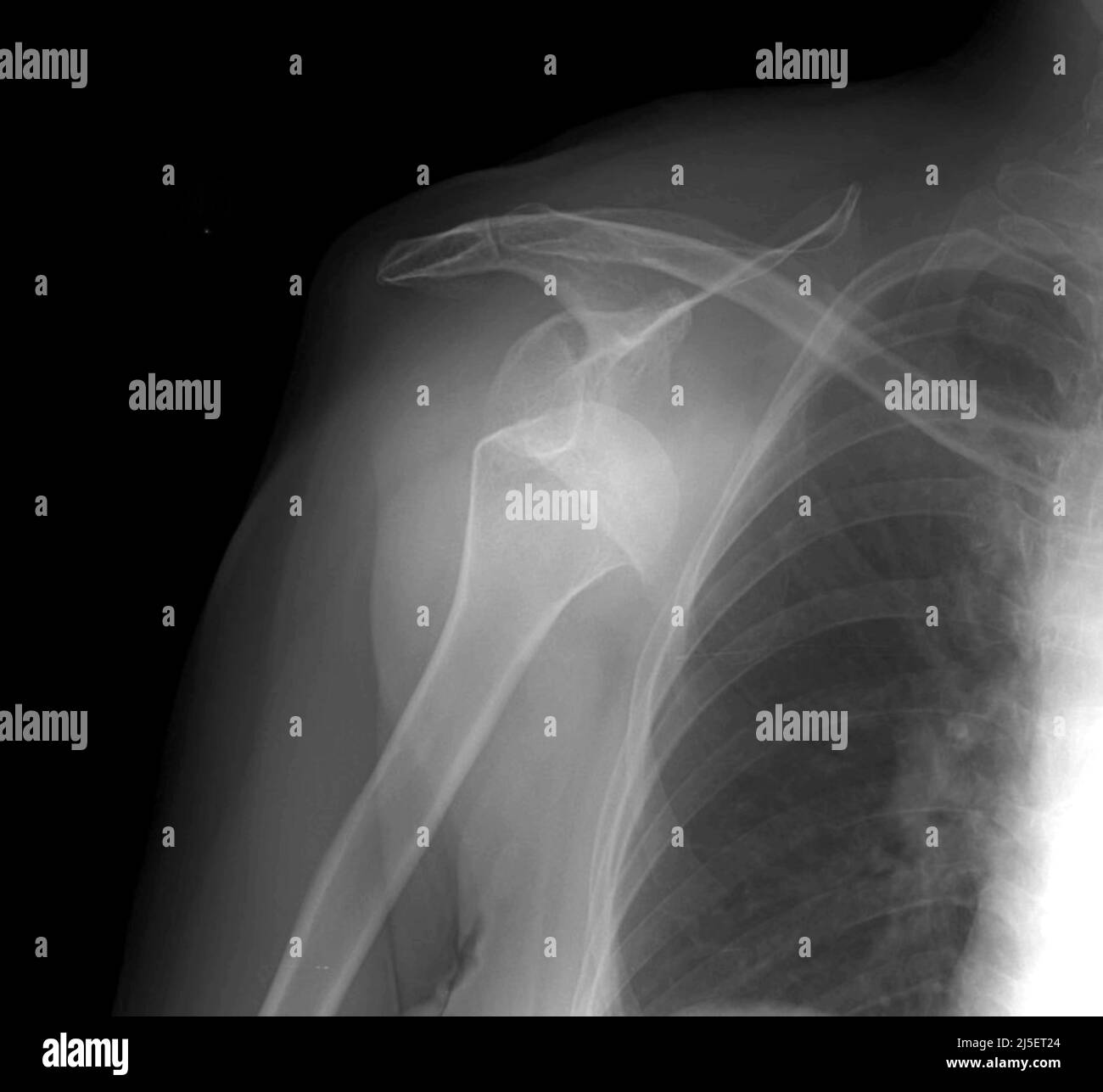 Dislocated right shoulder, Xray Stock Photo Alamy
