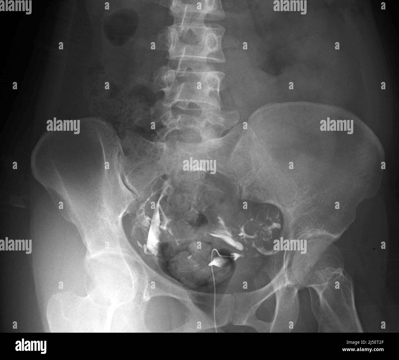 Fallopian tube of a patient with infertility, Xray Stock Photo Alamy