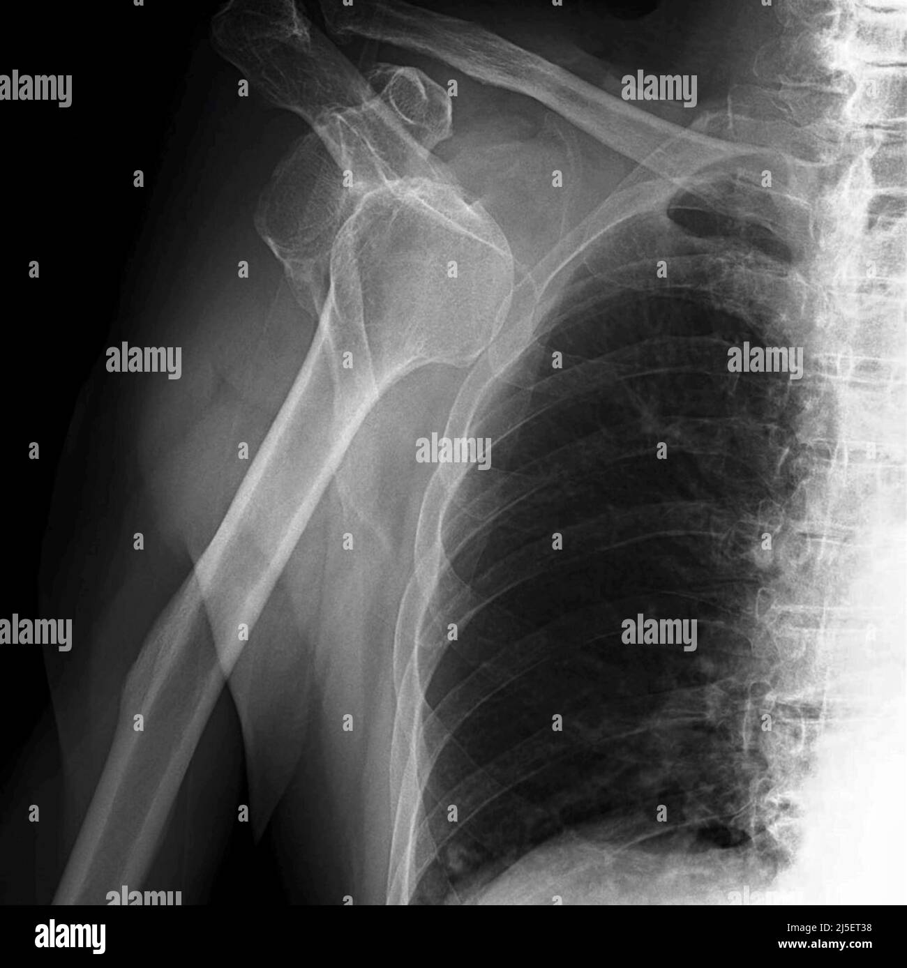 Dislocated right shoulder, Xray Stock Photo Alamy