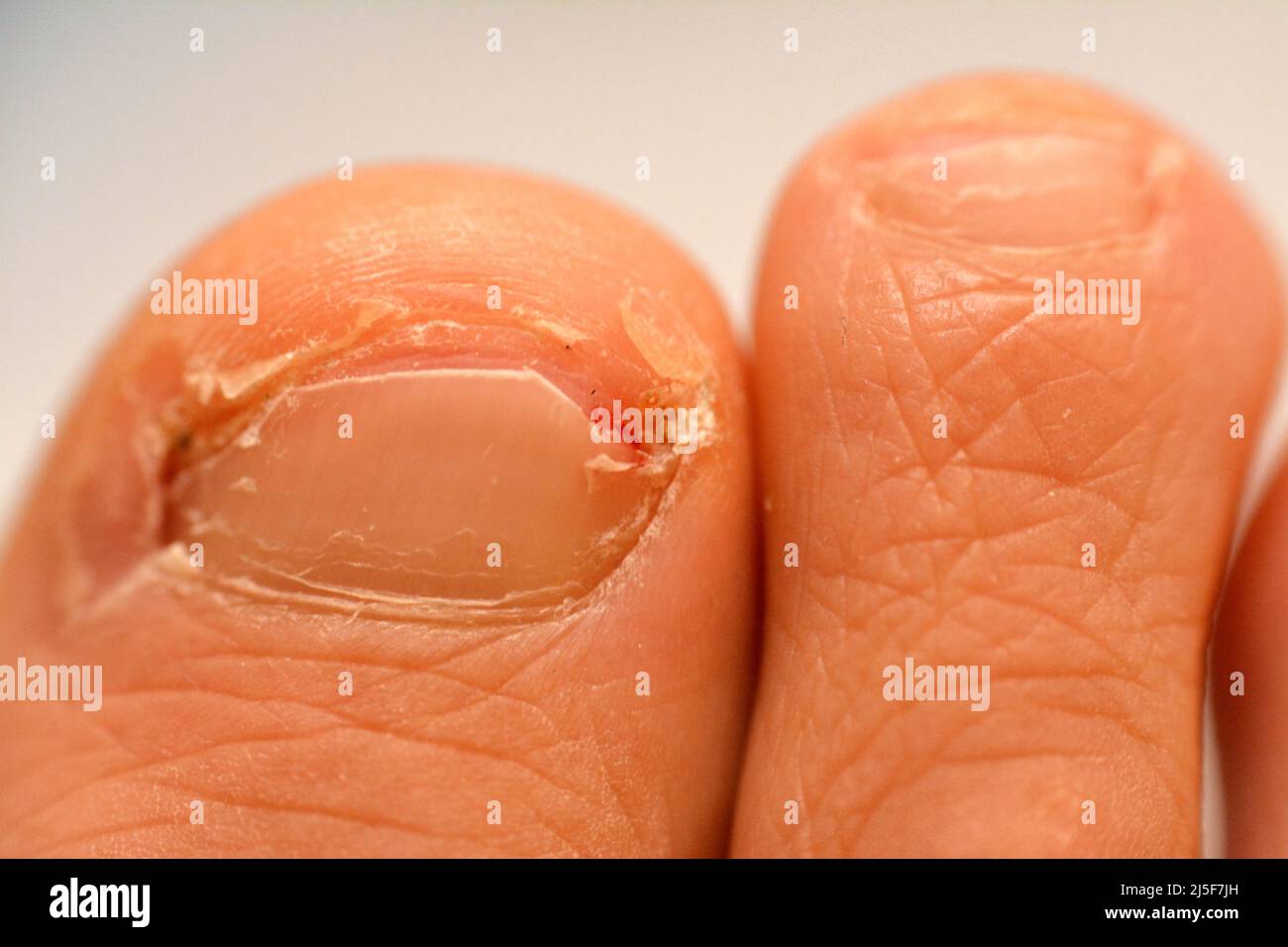 Toe nail injury hires stock photography and images Alamy