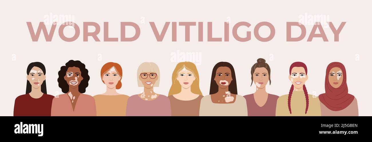 World vitiligo day June 25 horizontal banner. Female faces with different ethnics, skin colors, hairstyles with vitiligo skin disease. Body positive c Stock Vector