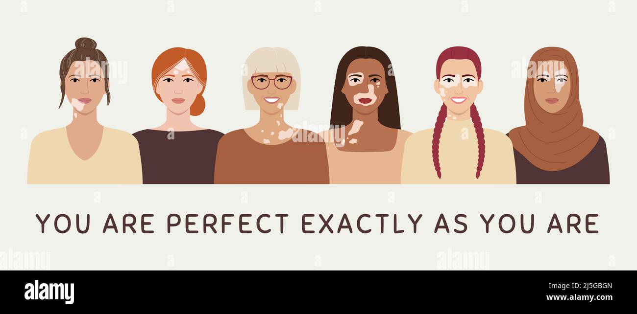 Female faces with vitiligo skin disease horizontal banner. You are perfect exactly as you are concept. Portraits with different ethnics, skin colors, Stock Vector