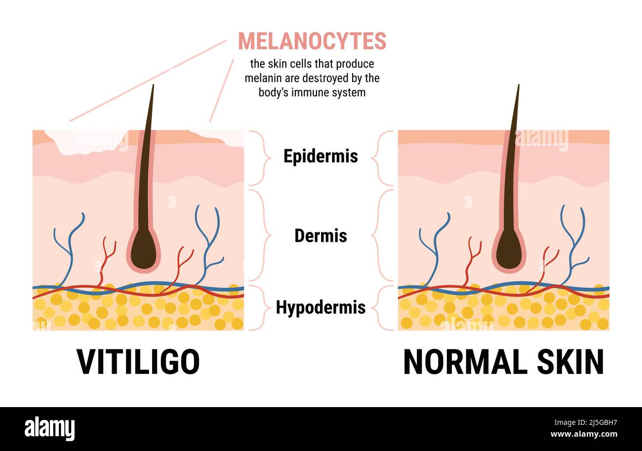 Vitiligo skin disease and healthy skin infographic. Skin anatomy. Melanocytes stop producing melanin. Flat vector illustration Stock Vector