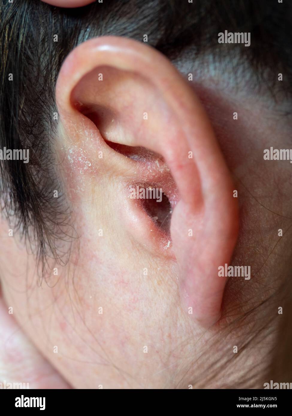 Ear Dry Hi Res Stock Photography And Images Alamy