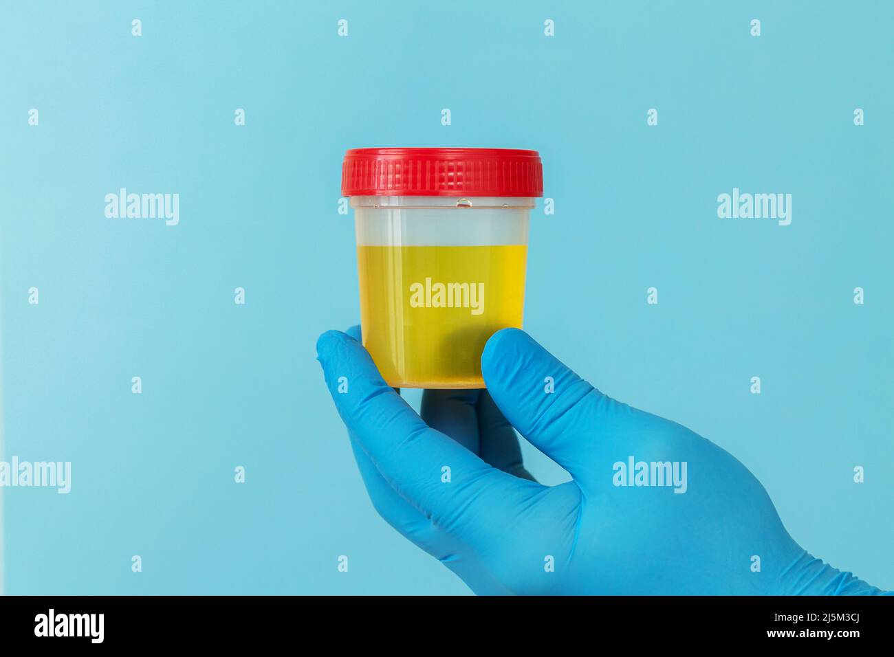 Container with urine sample for laboratory analysis on urinary