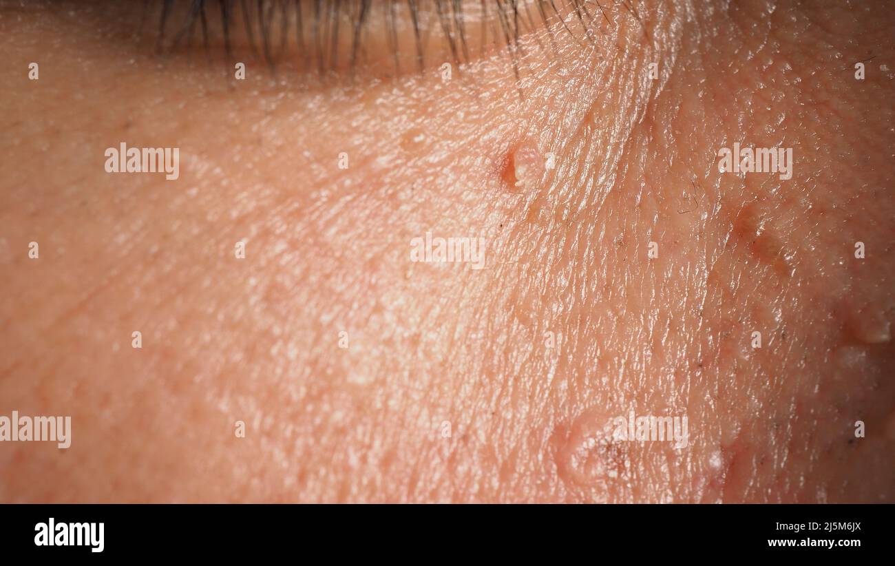 Wart skin removal. Macro shot of warts near eye on face. Papilloma on skin around eye nose and neck. Birthmark Papilla or mole on skin. small hard. be Stock Photo