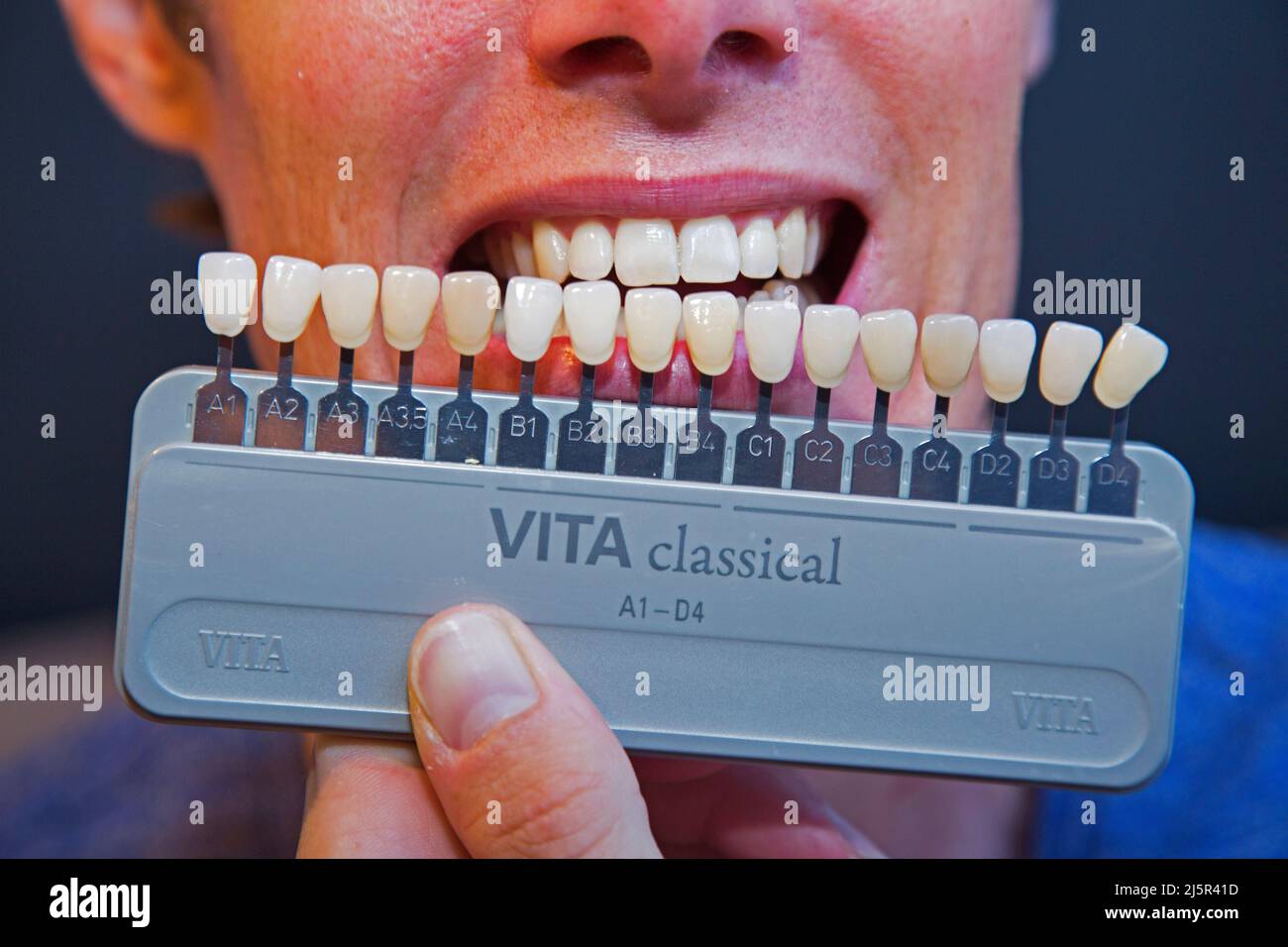 Colour samples of teeth to match the natural color of a patients teeth ...