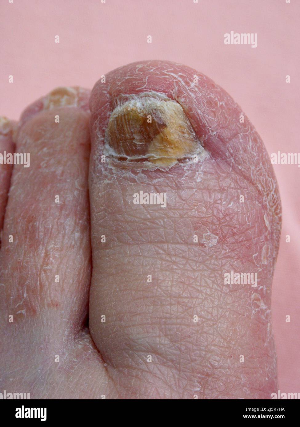 Brittle toenails hires stock photography and images Alamy