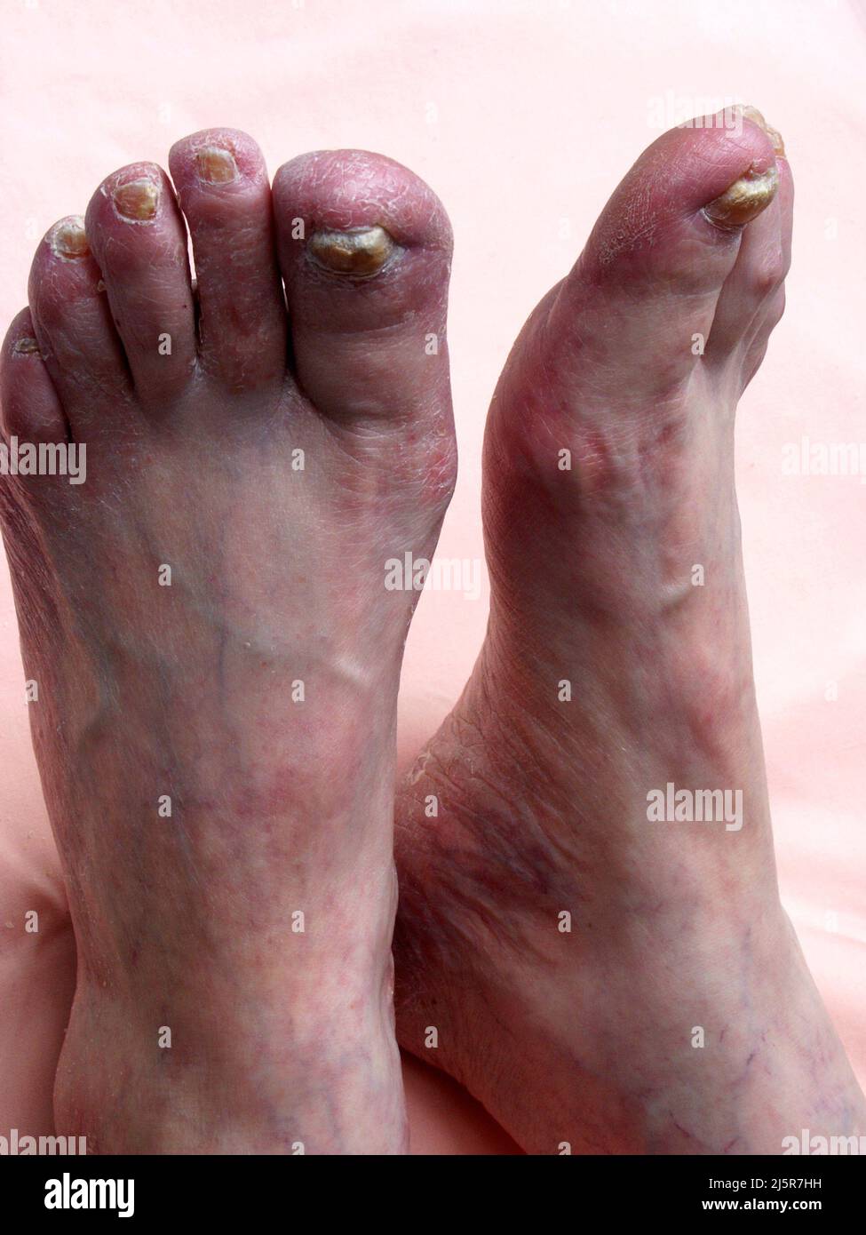 Toenail Fungal Infection, Onychomycosis, Stock Photo of Yellow Nails