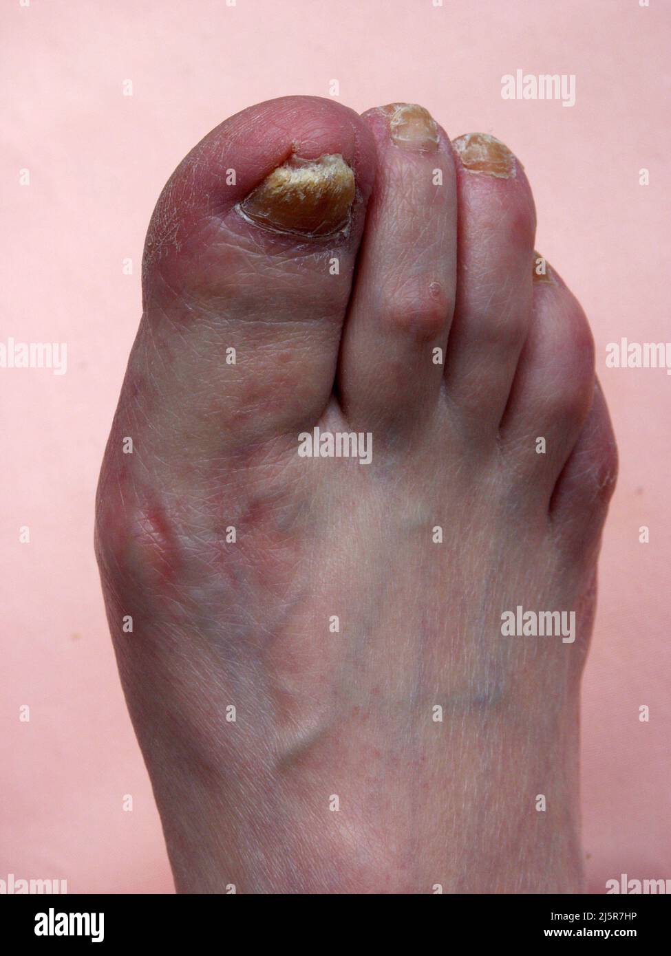 Brittle toenails hires stock photography and images Alamy